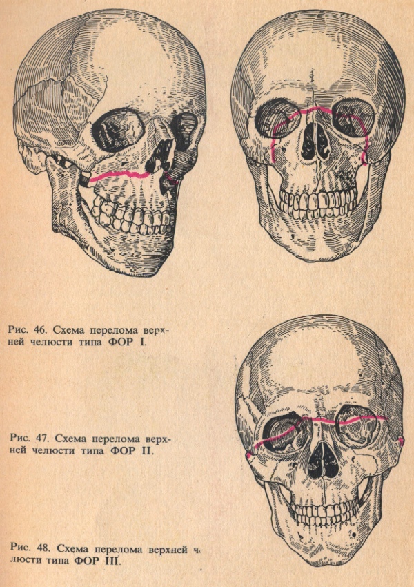 Схема перелома верхней челюсти