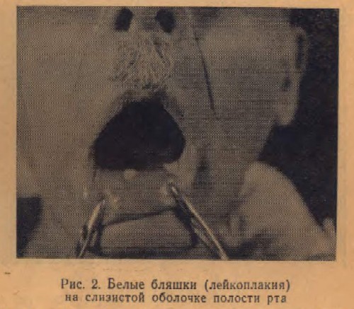 Белые бляшки (лейкоплакия) на слизистой оболочке полости рта