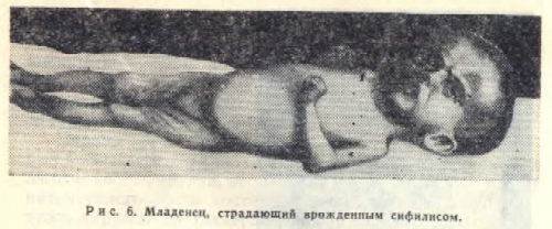 Младенец, страдающий врожденным сифилисом