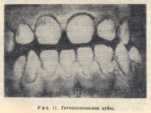 Гетчинсоновские зубы